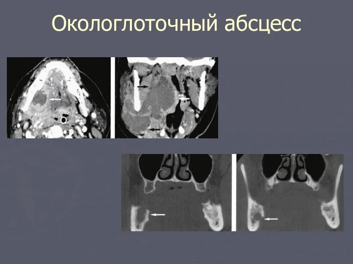 Окологлоточный абсцесс