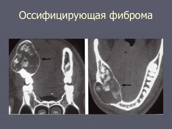 Оссифицирующая фиброма