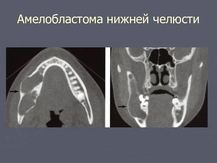 Амелобластома нижней челюсти