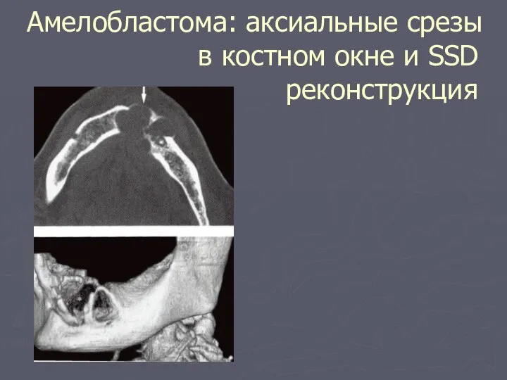 Амелобластома: аксиальные срезы в костном окне и SSD реконструкция