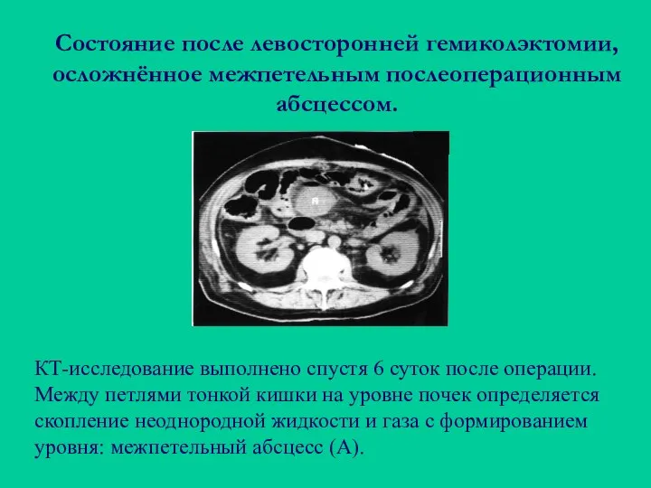 Состояние после левосторонней гемиколэктомии, осложнённое межпетельным послеоперационным абсцессом. КТ-исследование выполнено спустя