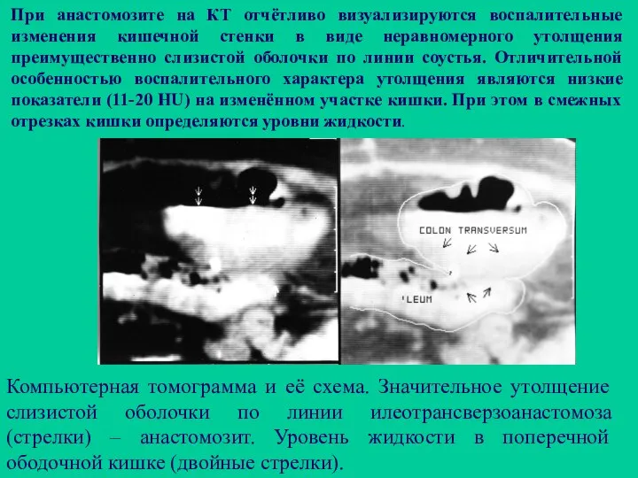 При анастомозите на КТ отчётливо визуализируются воспалительные изменения кишечной стенки в