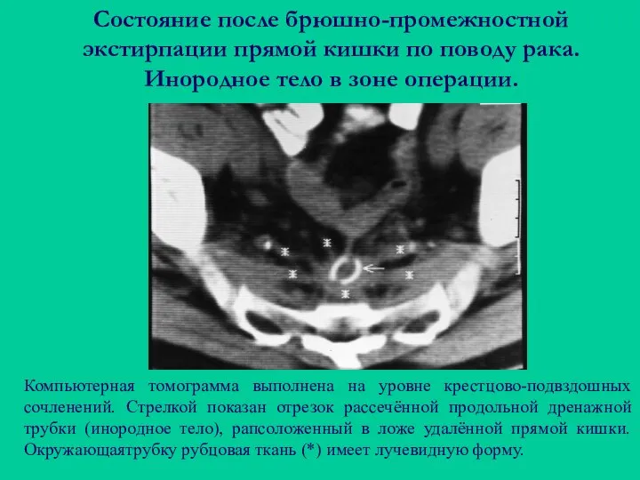 Состояние после брюшно-промежностной экстирпации прямой кишки по поводу рака. Инородное тело