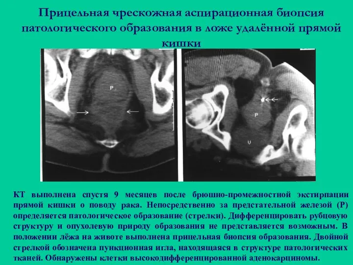 Прицельная чрескожная аспирационная биопсия патологического образования в ложе удалённой прямой кишки