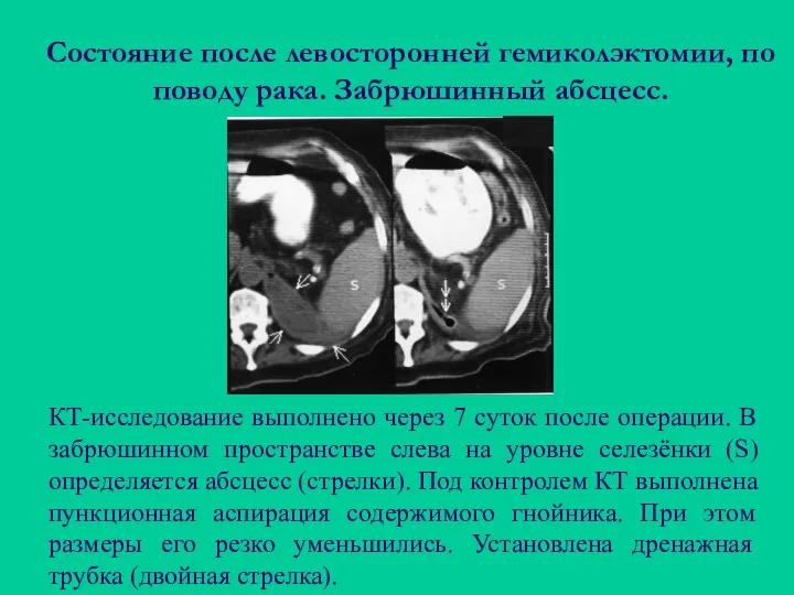 Состояние после левосторонней гемиколэктомии, по поводу рака. Забрюшинный абсцесс. КТ-исследование выполнено