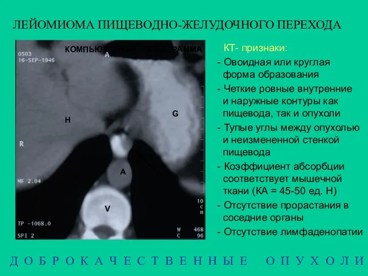 ЛЕЙОМИОМА ПИЩЕВОДНО-ЖЕЛУДОЧНОГО ПЕРЕХОДА КОМПЬЮТЕРНАЯ ТОМОГРАММА КТ- признаки: - Овоидная или круглая