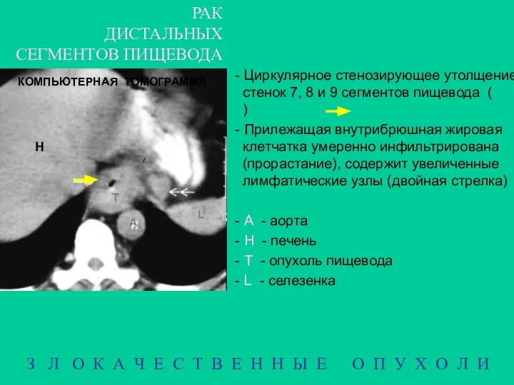 РАК ДИСТАЛЬНЫХ СЕГМЕНТОВ ПИЩЕВОДА З Л О К А Ч Е