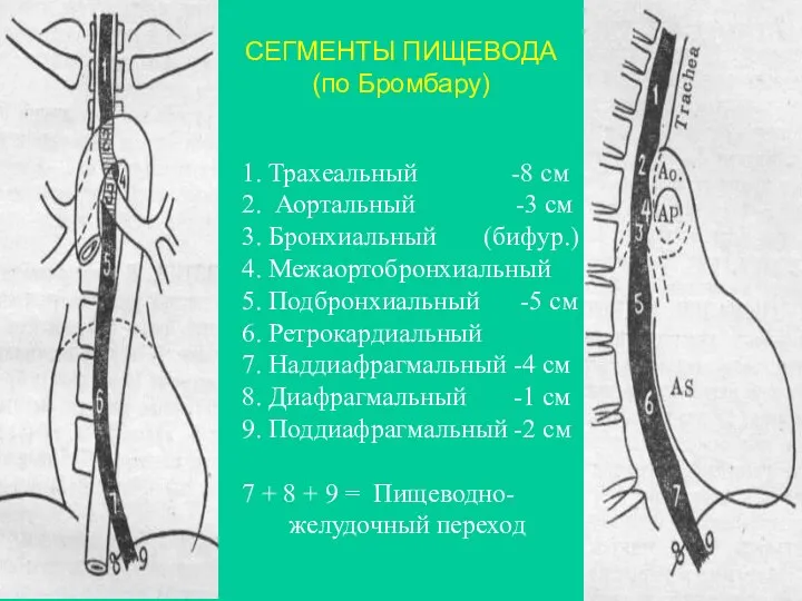 1. Трахеальный -8 см 2. Аортальный -3 см 3. Бронхиальный (бифур.)