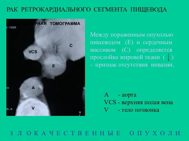 РАК РЕТРОКАРДИАЛЬНОГО СЕГМЕНТА ПИЩЕВОДА Е A VCS V З Л О