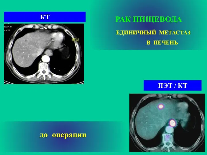 РАК ПИЩЕВОДА ЕДИНИЧНЫЙ МЕТАСТАЗ В ПЕЧЕНЬ ПЭТ / КТ КТ до операции