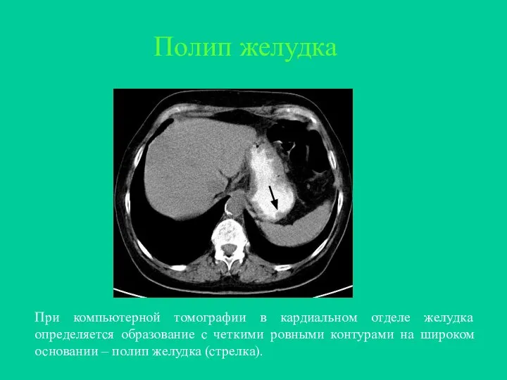 При компьютерной томографии в кардиальном отделе желудка определяется образование с четкими