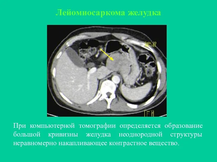 Лейомиосаркома желудка При компьютерной томографии определяется образование большой кривизны желудка неоднородной структуры неравномерно накапливающее контрастное вещество.