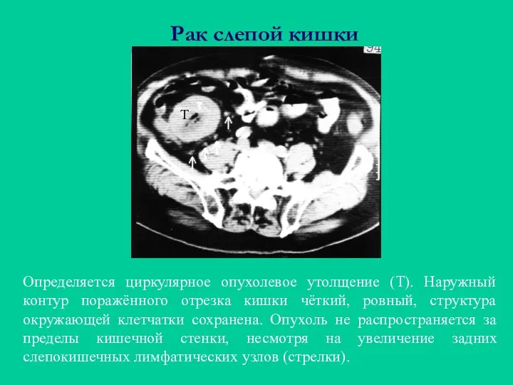 Рак слепой кишки Определяется циркулярное опухолевое утолщение (Т). Наружный контур поражённого