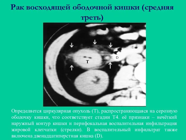 Рак восходящей ободочной кишки (средняя треть) Определяется циркулярная опухоль (Т), распространяющаяся