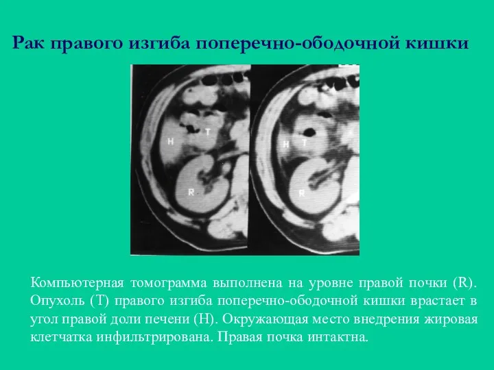 Рак правого изгиба поперечно-ободочной кишки Компьютерная томограмма выполнена на уровне правой