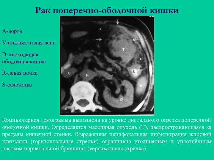 Рак поперечно-ободочной кишки Компьютерная томограмма выполнена на уровне дистального отрезка поперечной