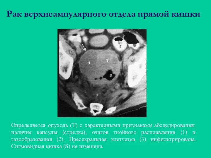 Рак верхнеампулярного отдела прямой кишки Определяется опухоль (Т) с характерными признаками