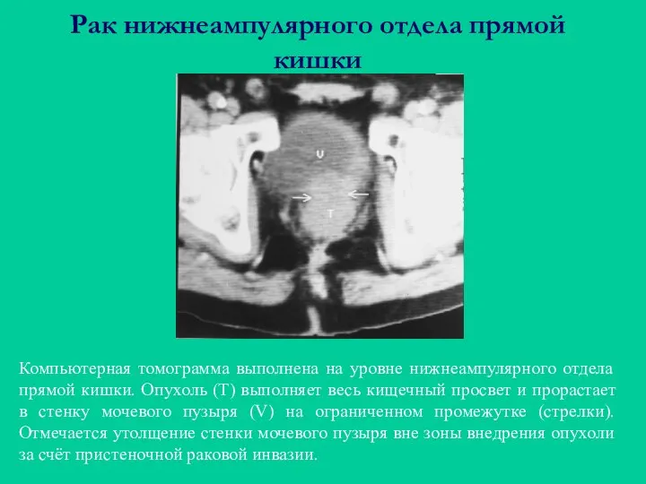 Рак нижнеампулярного отдела прямой кишки Компьютерная томограмма выполнена на уровне нижнеампулярного