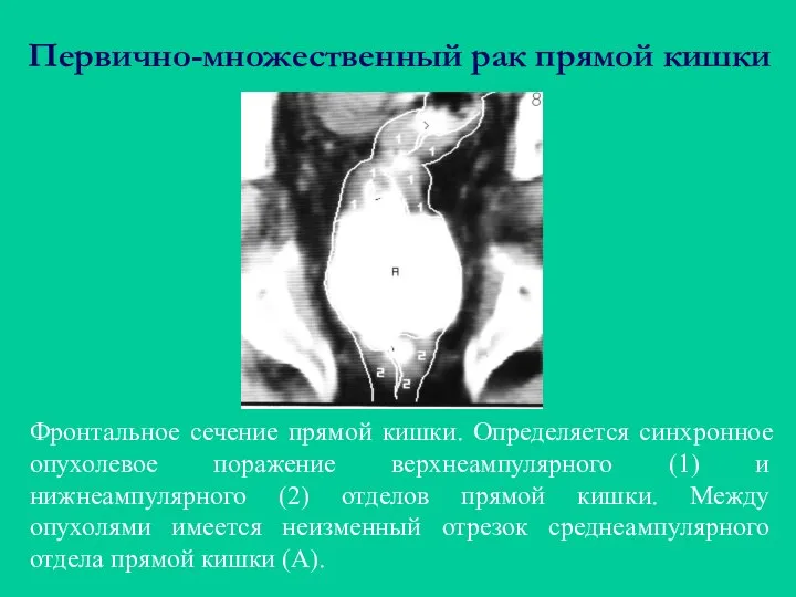 Первично-множественный рак прямой кишки Фронтальное сечение прямой кишки. Определяется синхронное опухолевое