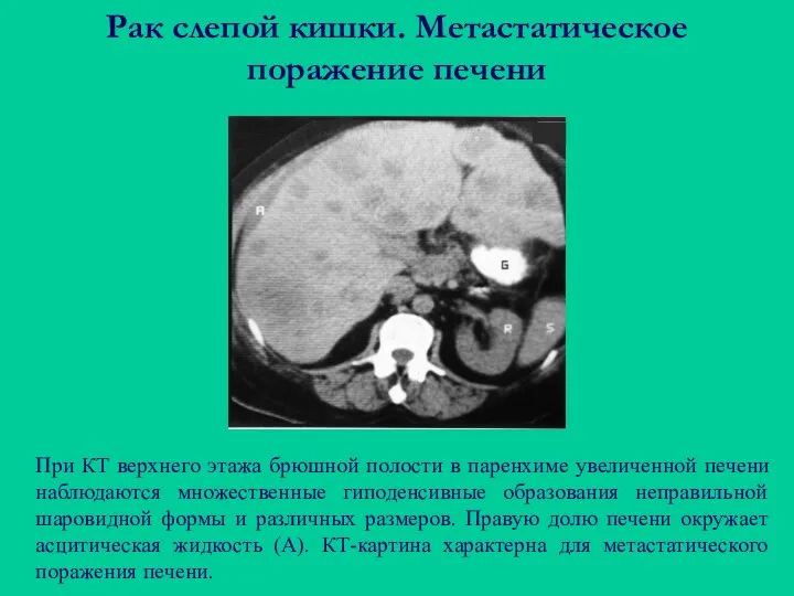 Рак слепой кишки. Метастатическое поражение печени При КТ верхнего этажа брюшной