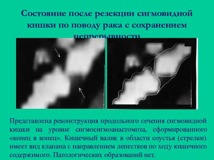 Состояние после резекции сигмовидной кишки по поводу рака с сохранением непрерывности