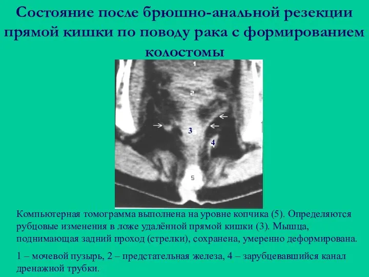 Состояние после брюшно-анальной резекции прямой кишки по поводу рака с формированием