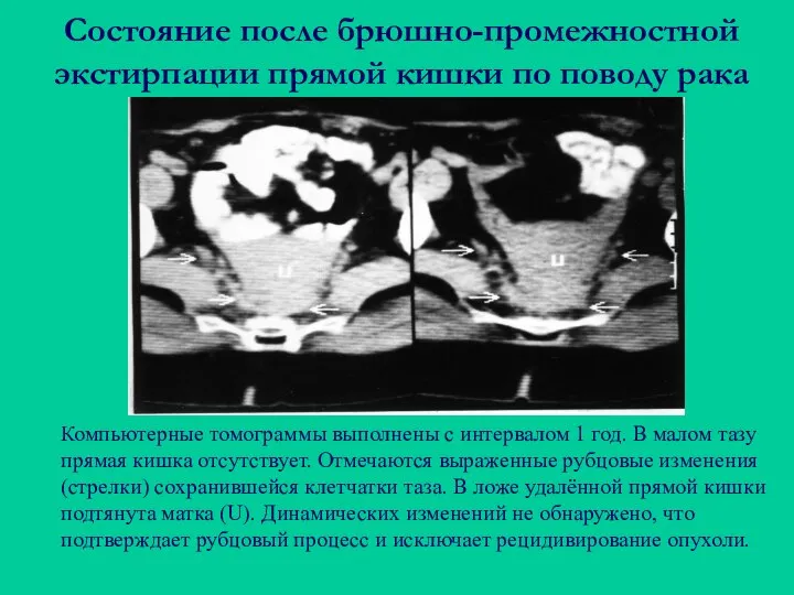 Состояние после брюшно-промежностной экстирпации прямой кишки по поводу рака Компьютерные томограммы