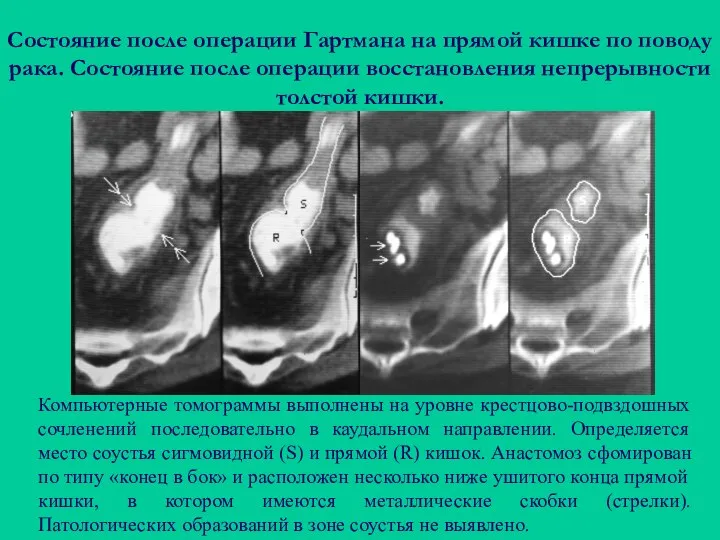 Состояние после операции Гартмана на прямой кишке по поводу рака. Состояние