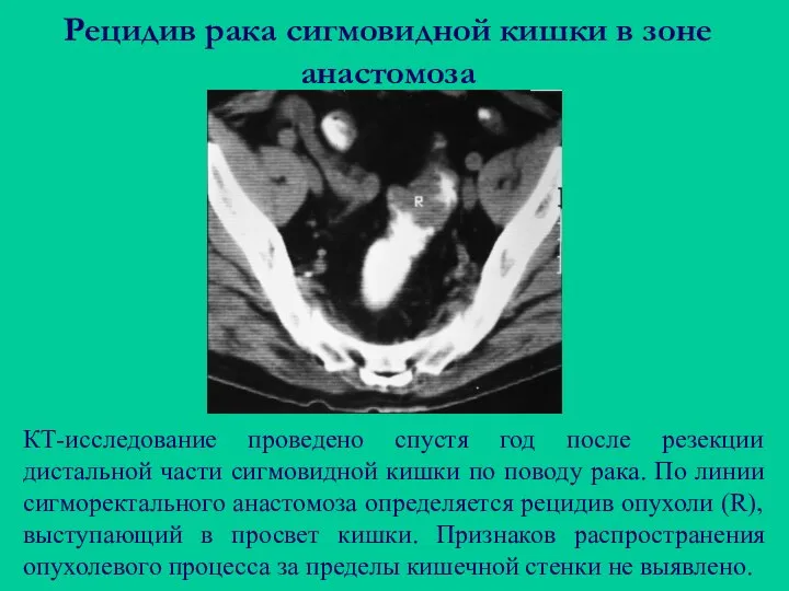 Рецидив рака сигмовидной кишки в зоне анастомоза КТ-исследование проведено спустя год