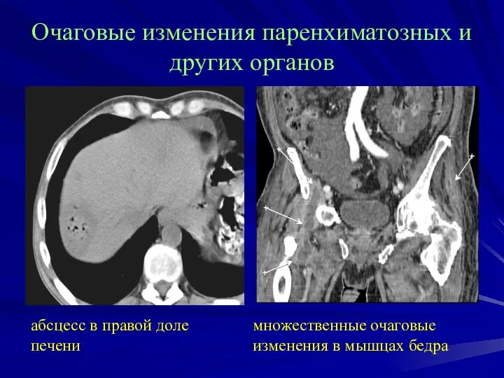 Очаговые изменения паренхиматозных и других органов абсцесс в правой доле печени