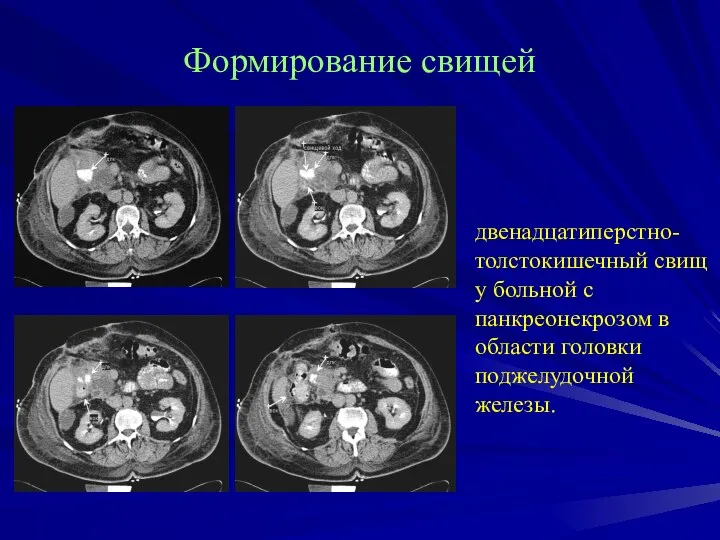 Формирование свищей двенадцатиперстно-толстокишечный свищ у больной с панкреонекрозом в области головки поджелудочной железы.