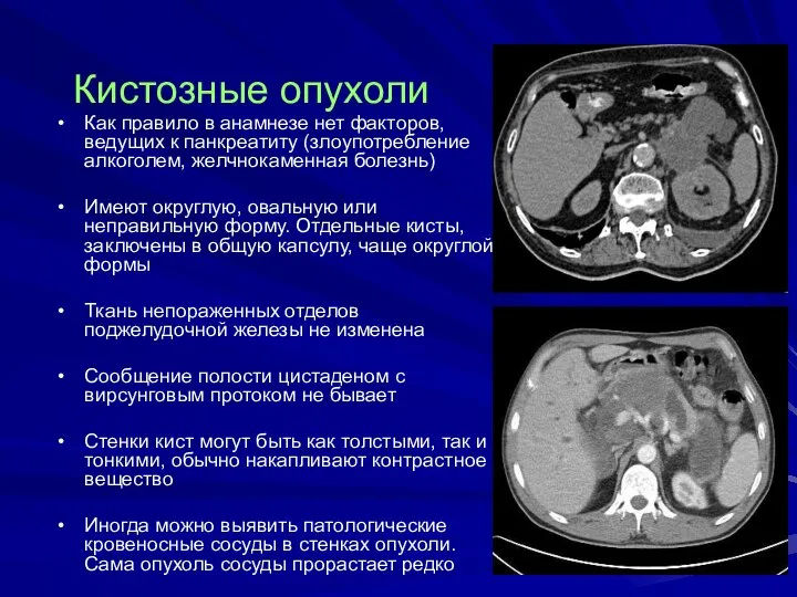 Кистозные опухоли Как правило в анамнезе нет факторов, ведущих к панкреатиту