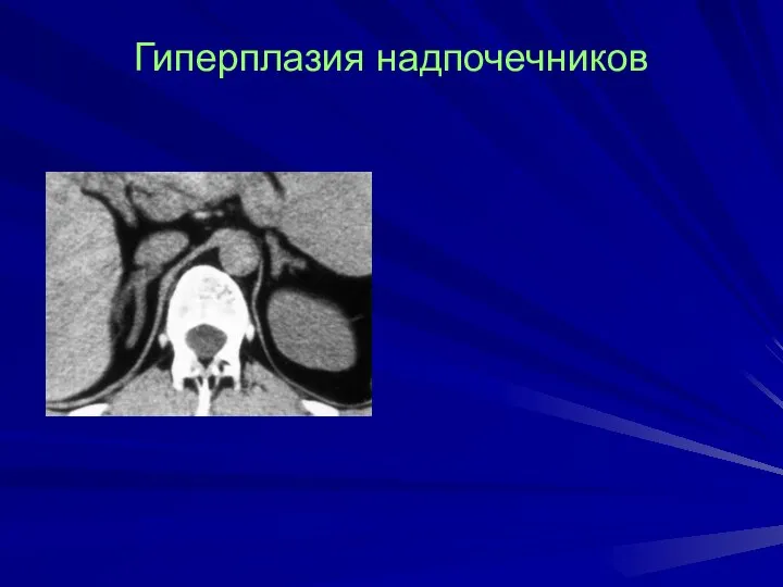 Гиперплазия надпочечников