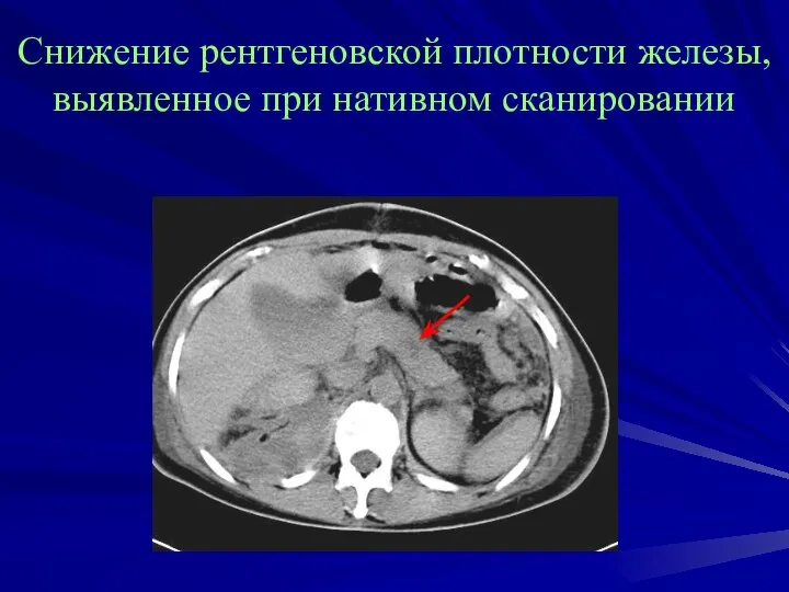 Снижение рентгеновской плотности железы, выявленное при нативном сканировании