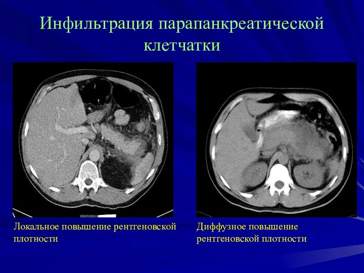 Инфильтрация парапанкреатической клетчатки Локальное повышение рентгеновской плотности Диффузное повышение рентгеновской плотности