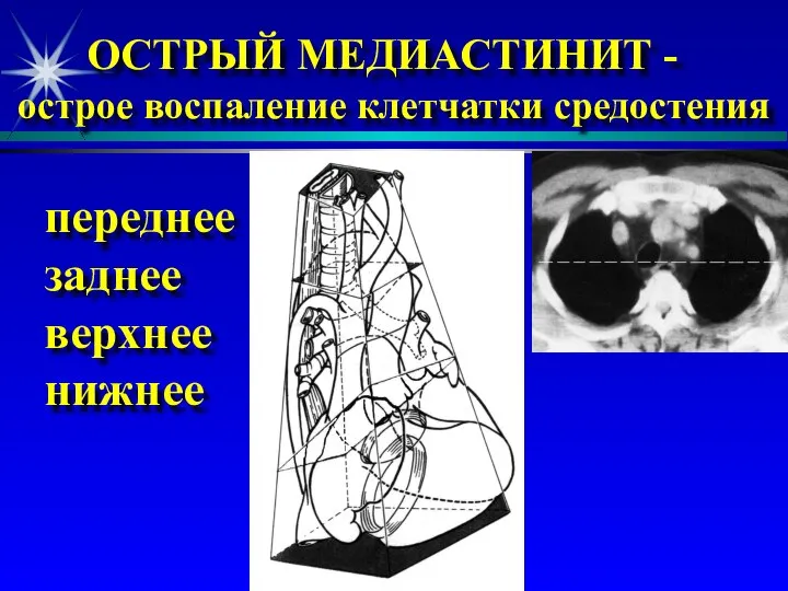 ОСТРЫЙ МЕДИАСТИНИТ - острое воспаление клетчатки средостения переднее заднее верхнее нижнее