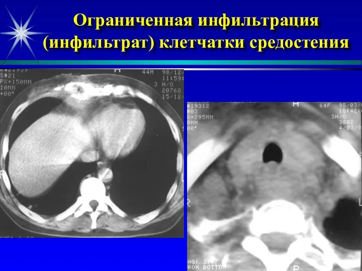 Ограниченная инфильтрация (инфильтрат) клетчатки средостения