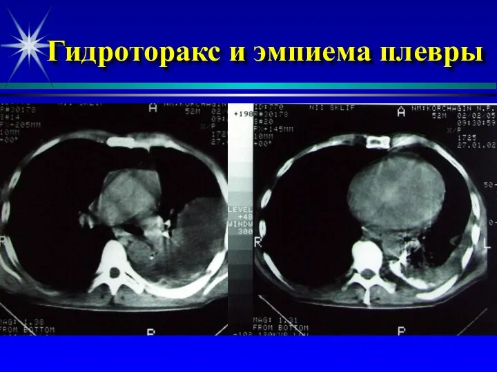 Гидроторакс и эмпиема плевры