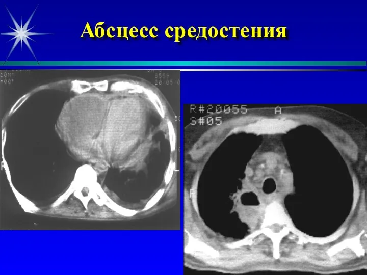 Абсцесс средостения