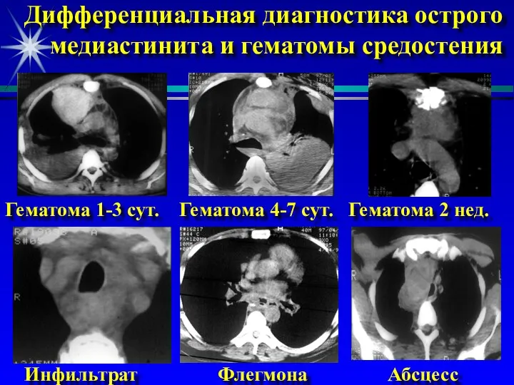 Дифференциальная диагностика острого медиастинита и гематомы средостения Гематома 1-3 сут. Гематома