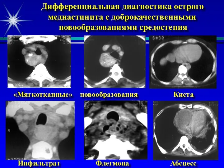 Дифференциальная диагностика острого медиастинита с доброкачественными новообразованиями средостения «Мягкотканные» новообразования Киста Инфильтрат Флегмона Абсцесс