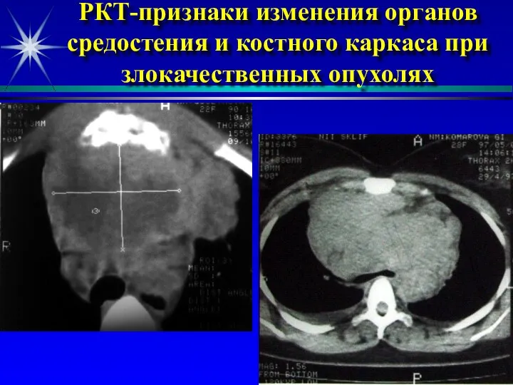 РКТ-признаки изменения органов средостения и костного каркаса при злокачественных опухолях