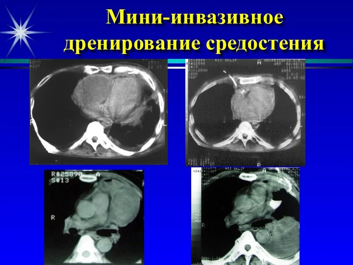 Мини-инвазивное дренирование средостения