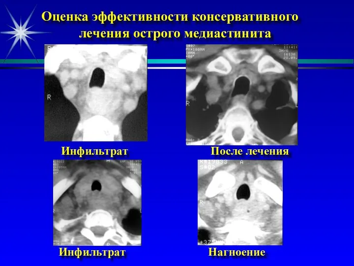 Оценка эффективности консервативного лечения острого медиастинита Инфильтрат После лечения Инфильтрат Нагноение