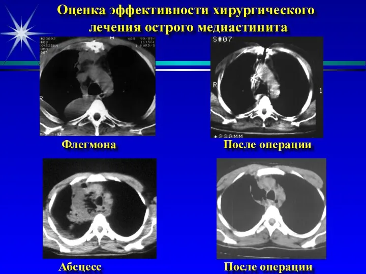 Оценка эффективности хирургического лечения острого медиастинита Флегмона После операции Абсцесс После операции