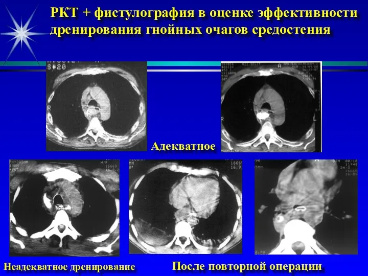 РКТ + фистулография в оценке эффективности дренирования гнойных очагов средостения Адекватное Неадекватное дренирование После повторной операции