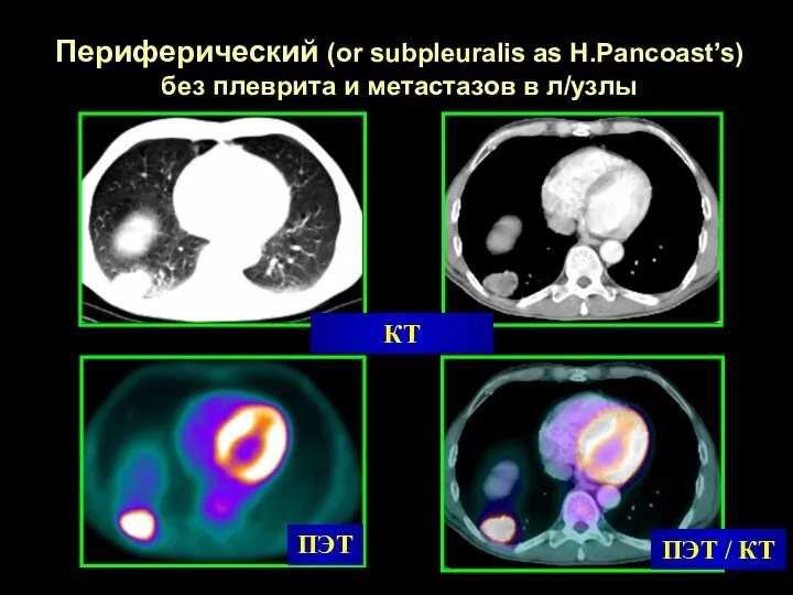 КТ ПЭТ / КТ ПЭТ Периферический (or subpleuralis as H.Pancoast’s) без плеврита и метастазов в л/узлы