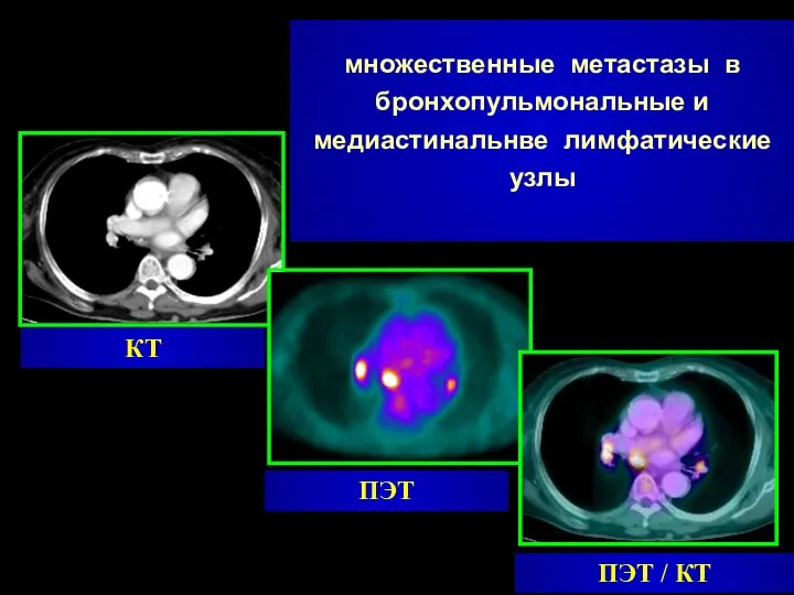 ПЭТ КТ ПЭТ / КТ множественные метастазы в бронхопульмональные и медиастинальнве лимфатические узлы