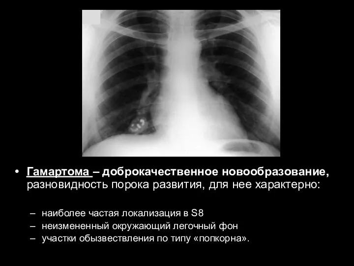 Гамартома – доброкачественное новообразование, разновидность порока развития, для нее характерно: наиболее