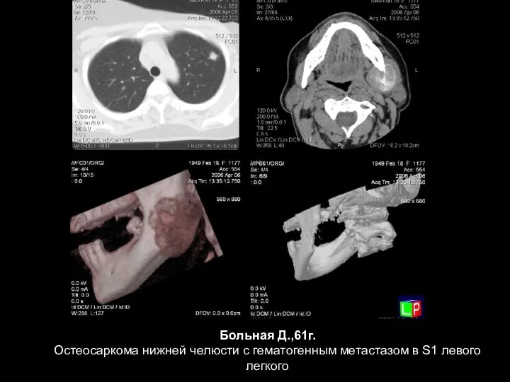 Больная Д.,61г. Остеосаркома нижней челюсти с гематогенным метастазом в S1 левого легкого